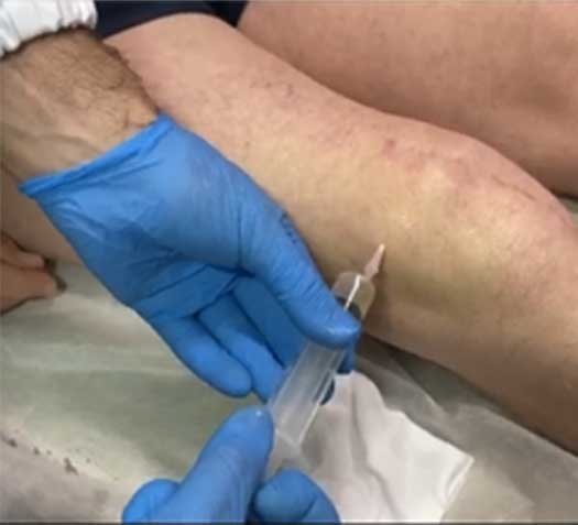 Mesoterapia-antalgica-e-infiltrazioni-al-ginocchio