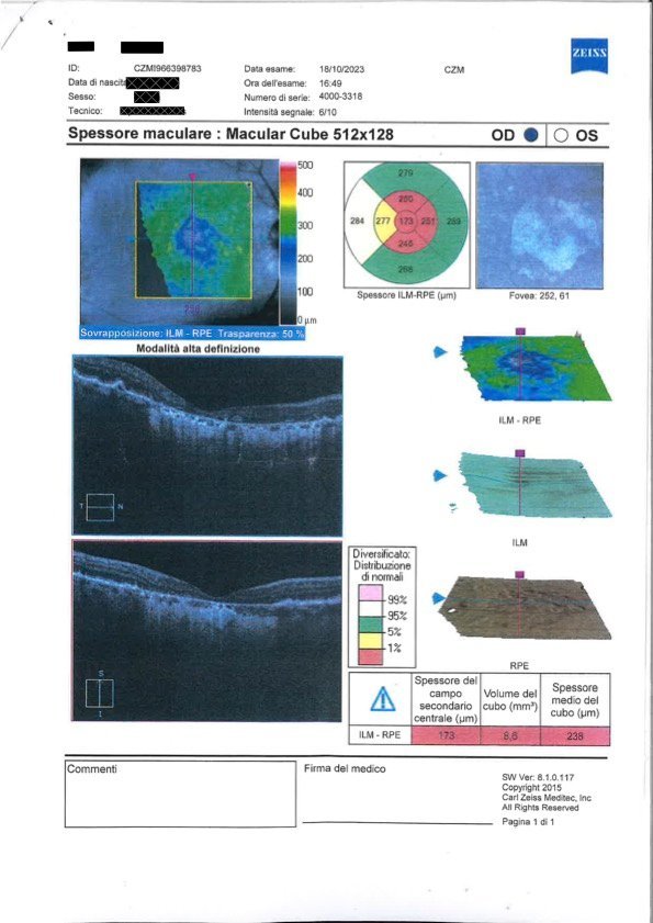 Degenerazione maculare secca 1