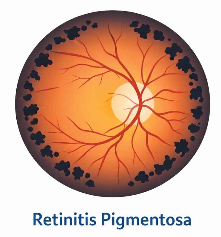 Retinite-pigmentosa